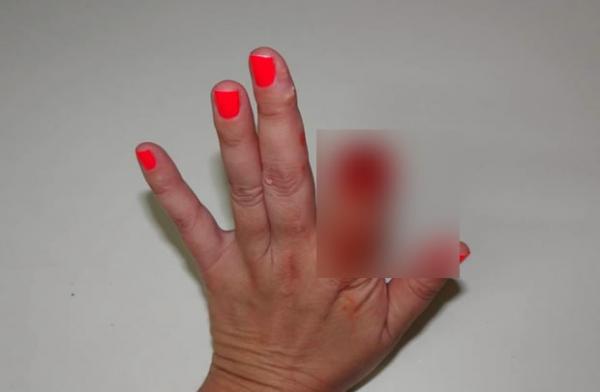 Ex-mulher não aceita separação e arranca pedaço do dedo da atual esposa do ex-marido